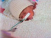 Девочке, при рождении весом 526 граммов, оперировали сердце.